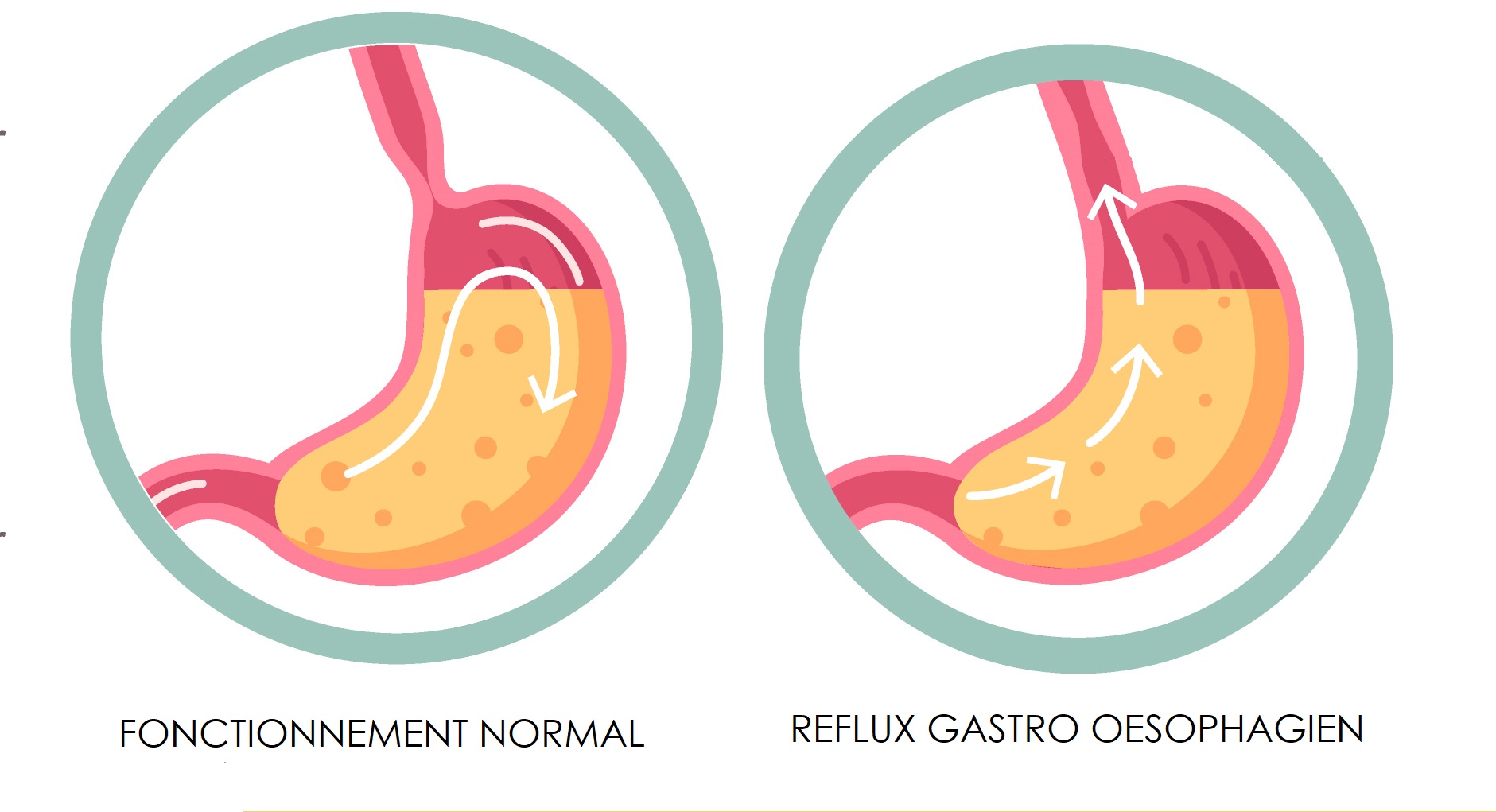 Le reflux gastro oesophagien - Laurence Murillo